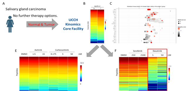 Signal transduction in HNSCC: From kinome profiling to molecular targeting. (A) Human cancer of the head and neck region (Biorender). (B) Human primary normal tissue and tumor samples were (C) analyzed using functional kinome profiling (see above) and kinases of the Src-family (SFK) were identified to be frequently upregulated in HNSCC. (D) SFK hyperactivity (increased SFK-autophosphorylation) is associated with worse prognosis in advanced HNSCC. (F) In SAS cells increased kinase activity can be blocked by SFK-inhibitor SU6656 and Abl/Src inhibitor Dasatinib. (F) Both inhibitos also block cell proliferation in head & neck tumor cell lines. (data from Bussmann et al., 2021, Int J Cancer & Thu Vu et al., 2023, Head Neck)